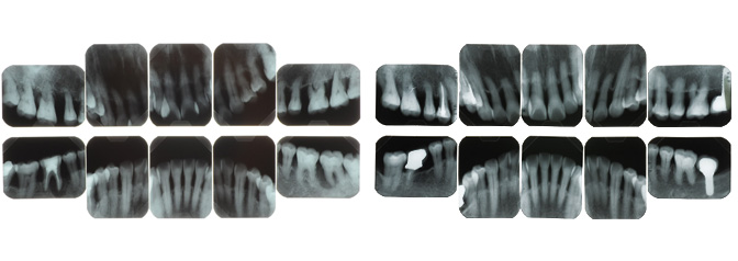 歯周治療前後のレントゲン